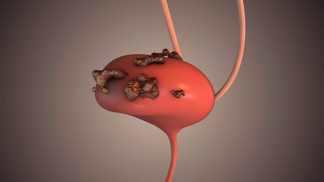Understanding Bladder Cancer: Types, Treatments, and What’s Ahead at ...